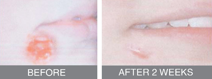 infected-wound-under-mouth-recovery