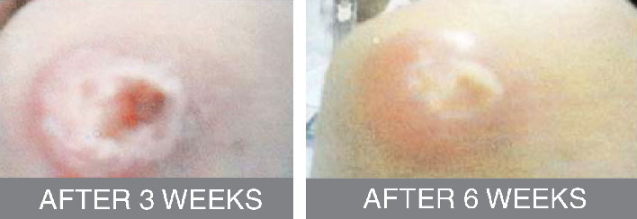 Recovery from open wound